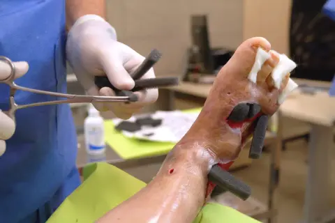 Kanarek kuleje? Leczenie łapek, odciski, pododermatitis!